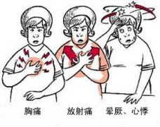 冠心病有哪些癥狀？