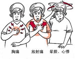 冠心病有哪些癥狀？(圖1)