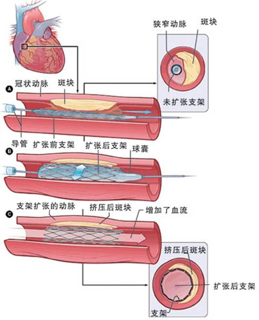 怎樣治療冠心??？(圖2)