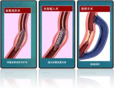 怎樣治療冠心??？