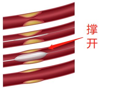 什么是藥物球囊？(圖2)